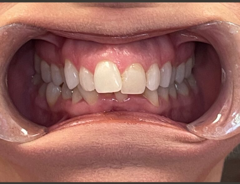 Before Image: case 9 - front