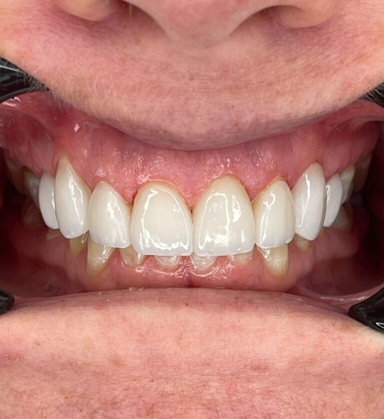 After Image: case 8 - front