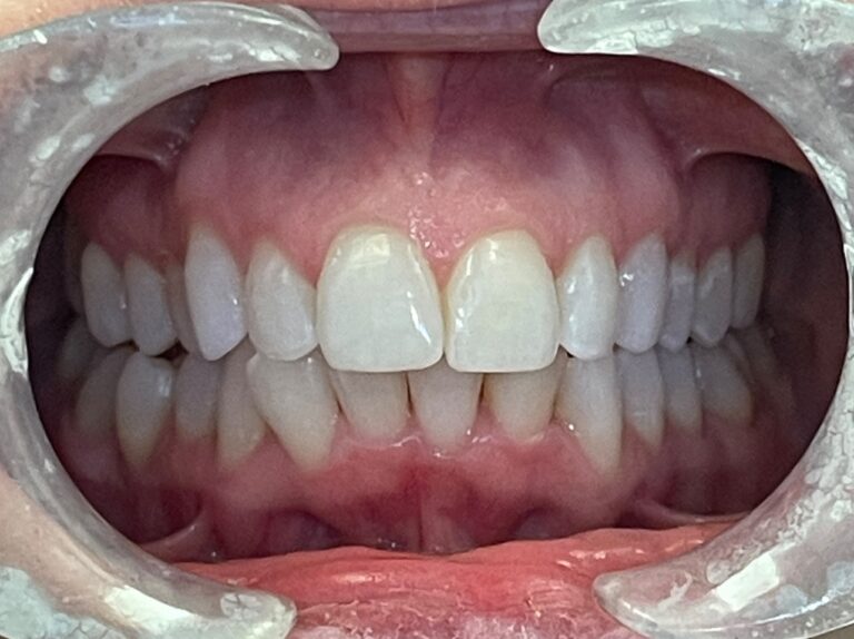 After Image: case 9 - front